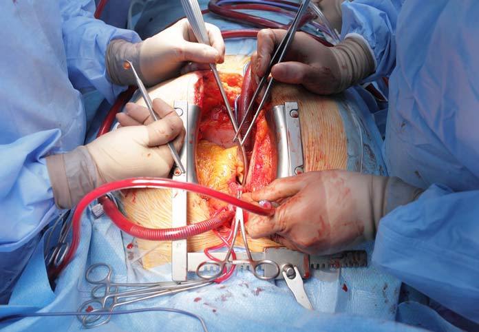 Cardiac Surgery 